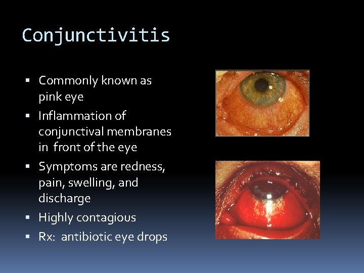 Conjunctivitis Commonly known as pink eye Inflammation of conjunctival membranes in front of the