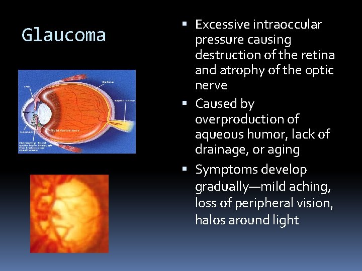 Glaucoma Excessive intraoccular pressure causing destruction of the retina and atrophy of the optic