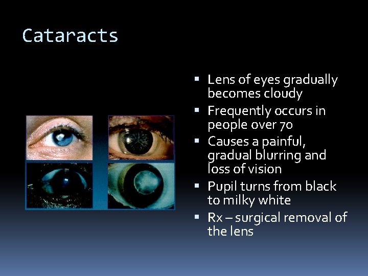 Cataracts Lens of eyes gradually becomes cloudy Frequently occurs in people over 70 Causes