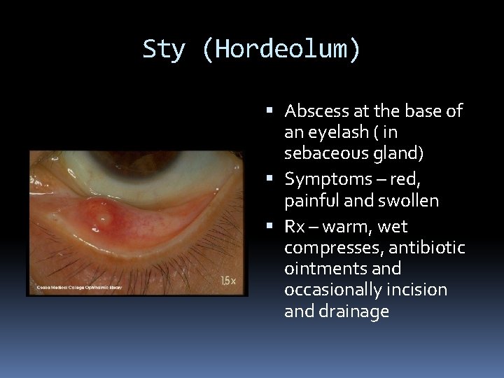Sty (Hordeolum) Abscess at the base of an eyelash ( in sebaceous gland) Symptoms