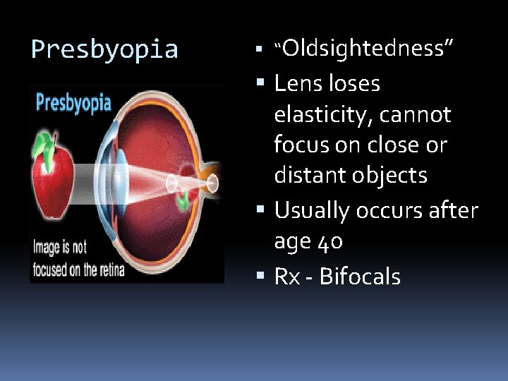 Presbyopia “Oldsightedness” Lens loses elasticity, cannot focus on close or distant objects Usually occurs