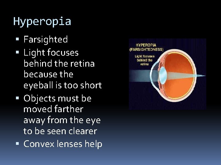 Hyperopia Farsighted Light focuses behind the retina because the eyeball is too short Objects