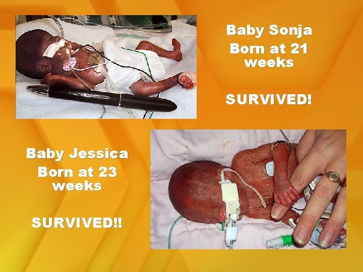 Baby Sonja Born at 21 weeks SURVIVED! Baby Jessica Born at 23 weeks SURVIVED!!