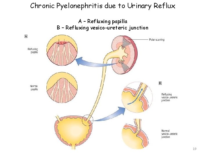 Chronic Pyelonephritis due to Urinary Reflux A – Refluxing papilla B – Refluxing vesico-ureteric