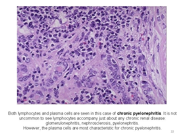 Both lymphocytes and plasma cells are seen in this case of chronic pyelonephritis. It