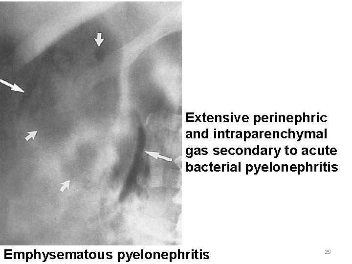 Extensive perinephric and intraparenchymal gas secondary to acute bacterial pyelonephritis Emphysematous pyelonephritis 29 