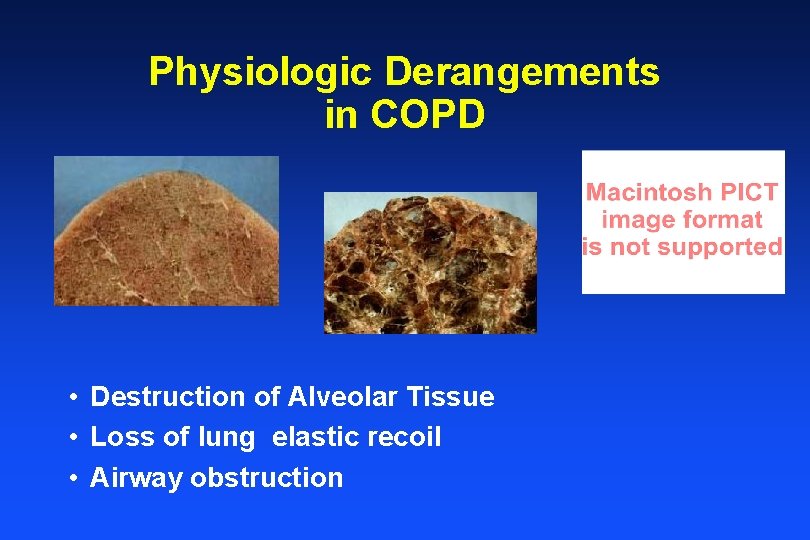 Physiologic Derangements in COPD • Destruction of Alveolar Tissue • Loss of lung elastic