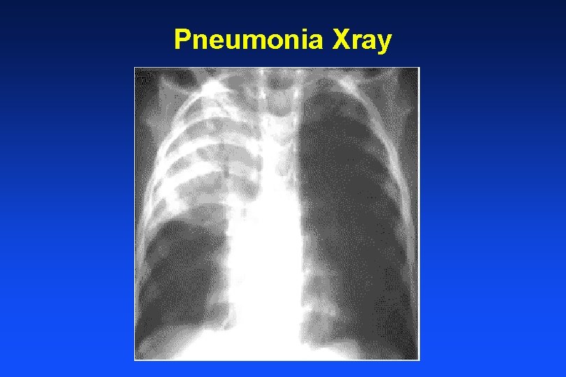Pneumonia Xray 