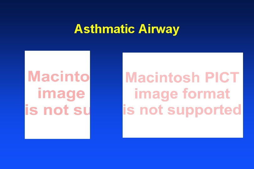 Asthmatic Airway 