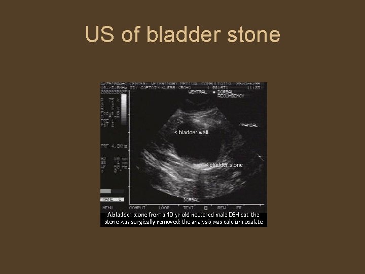 US of bladder stone 