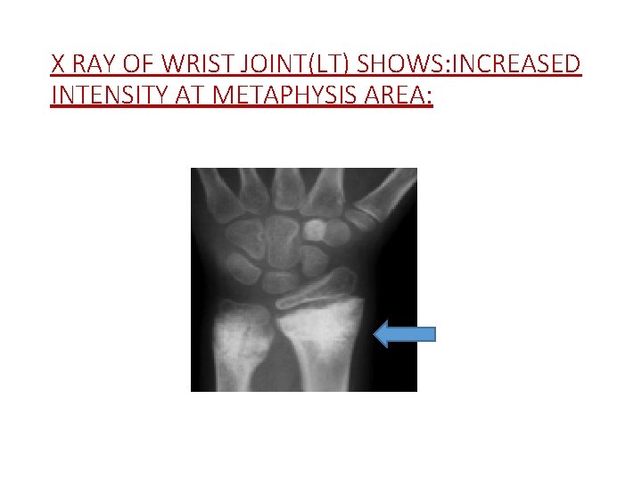 X RAY OF WRIST JOINT(LT) SHOWS: INCREASED INTENSITY AT METAPHYSIS AREA: 