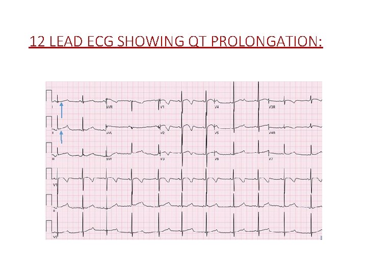 12 LEAD ECG SHOWING QT PROLONGATION: 