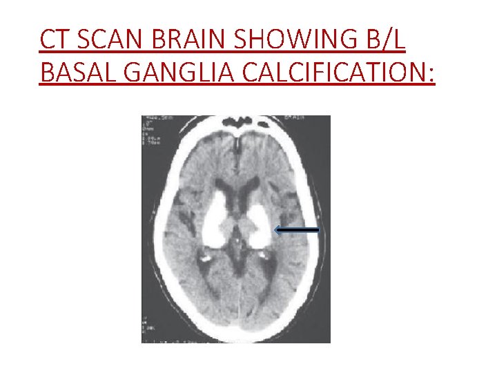 CT SCAN BRAIN SHOWING B/L BASAL GANGLIA CALCIFICATION: 