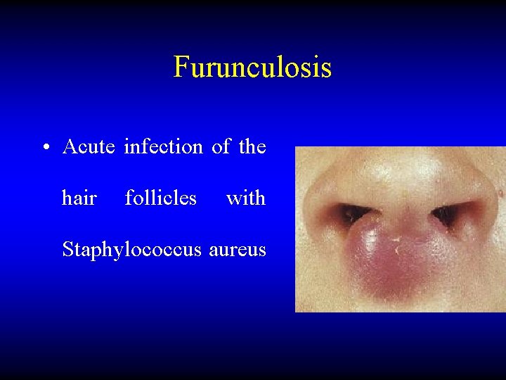 Furunculosis • Acute infection of the hair follicles with Staphylococcus aureus 