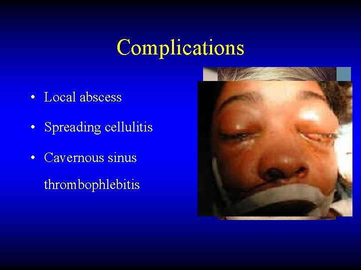 Complications • Local abscess • Spreading cellulitis • Cavernous sinus thrombophlebitis 