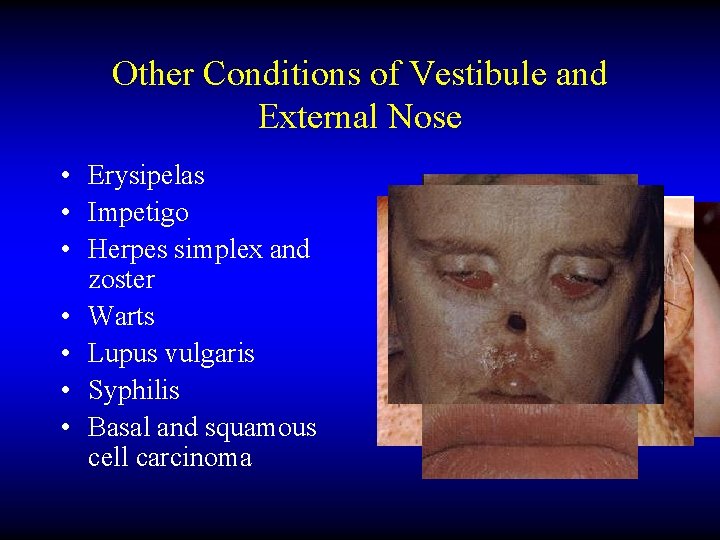 Other Conditions of Vestibule and External Nose • Erysipelas • Impetigo • Herpes simplex