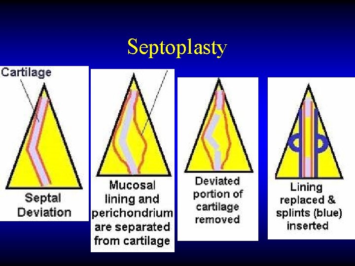Septoplasty 