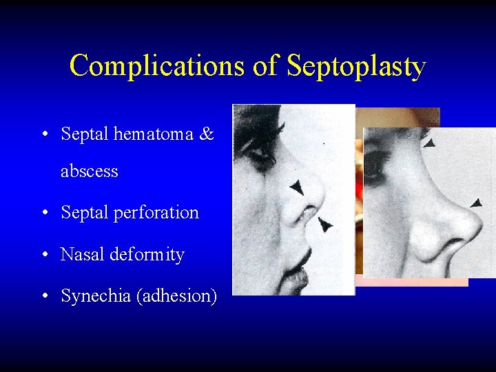 Complications of Septoplasty • Septal hematoma & abscess • Septal perforation • Nasal deformity