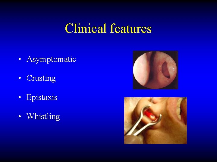 Clinical features • Asymptomatic • Crusting • Epistaxis • Whistling 