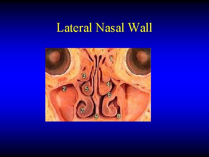 Lateral Nasal Wall 