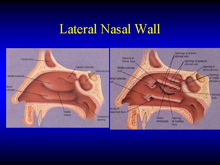 Lateral Nasal Wall 