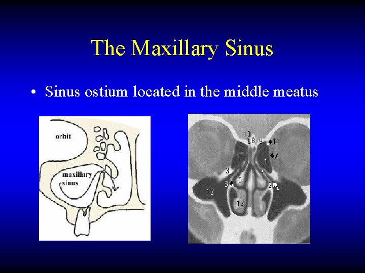 The Maxillary Sinus • Sinus ostium located in the middle meatus 