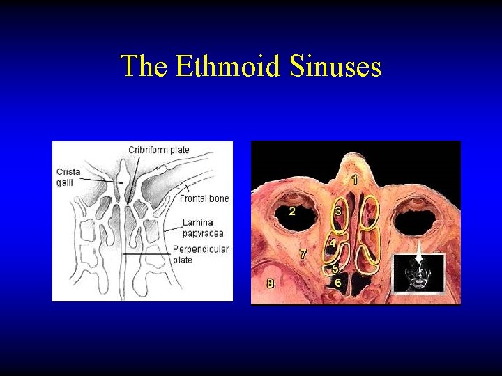 The Ethmoid Sinuses 