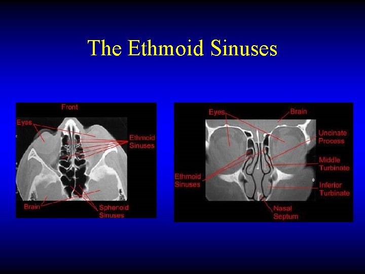 The Ethmoid Sinuses 
