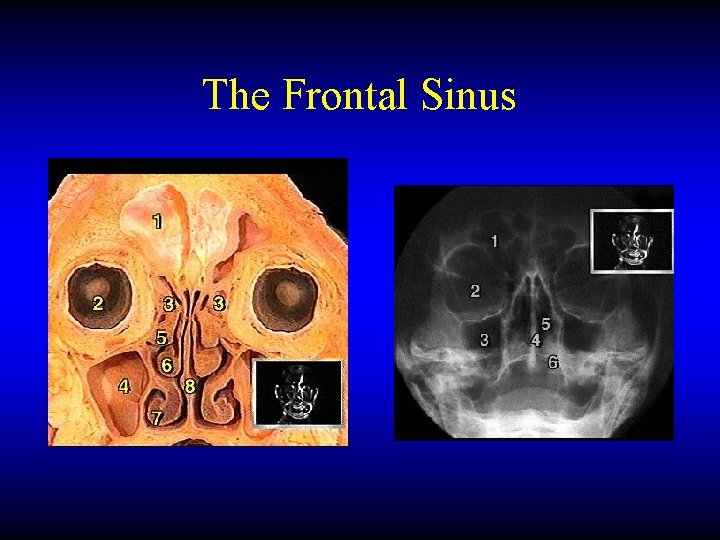The Frontal Sinus 
