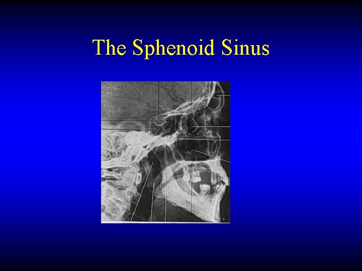 The Sphenoid Sinus 
