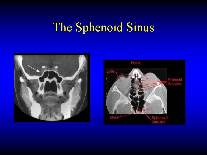 The Sphenoid Sinus 