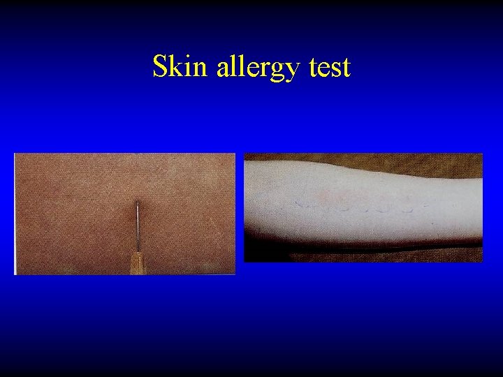 Skin allergy test 