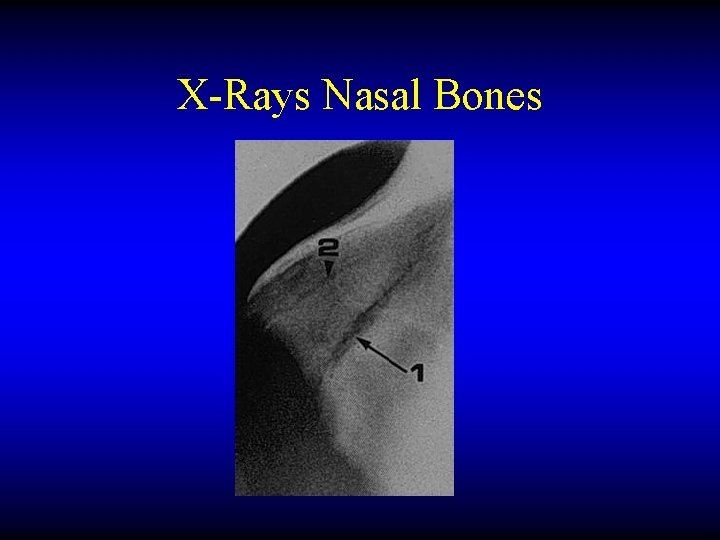X-Rays Nasal Bones 