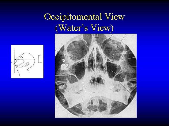 Occipitomental View (Water’s View) 