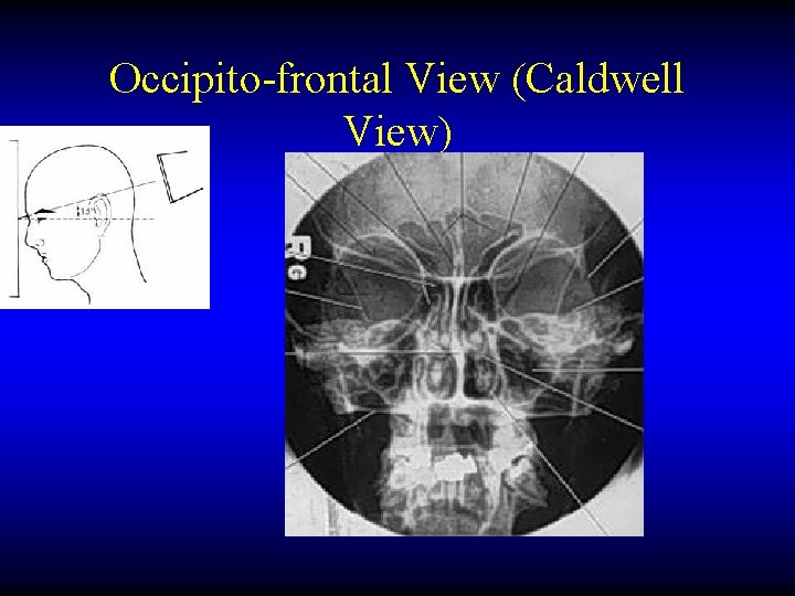 Occipito-frontal View (Caldwell View) 