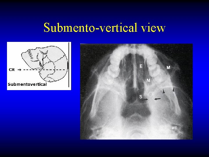 Submento-vertical view 
