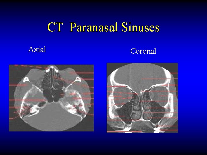 CT Paranasal Sinuses Axial Coronal 