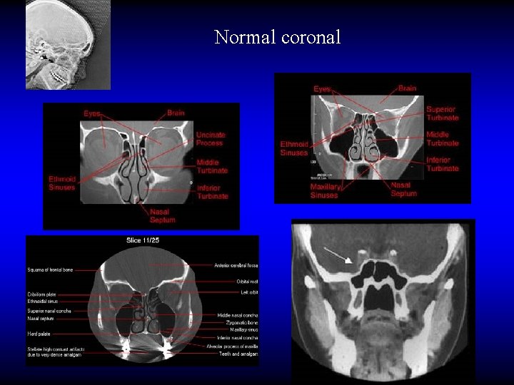 Normal coronal 