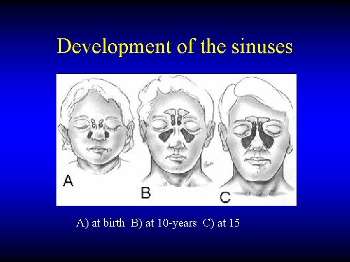Development of the sinuses A) at birth B) at 10 -years C) at 15