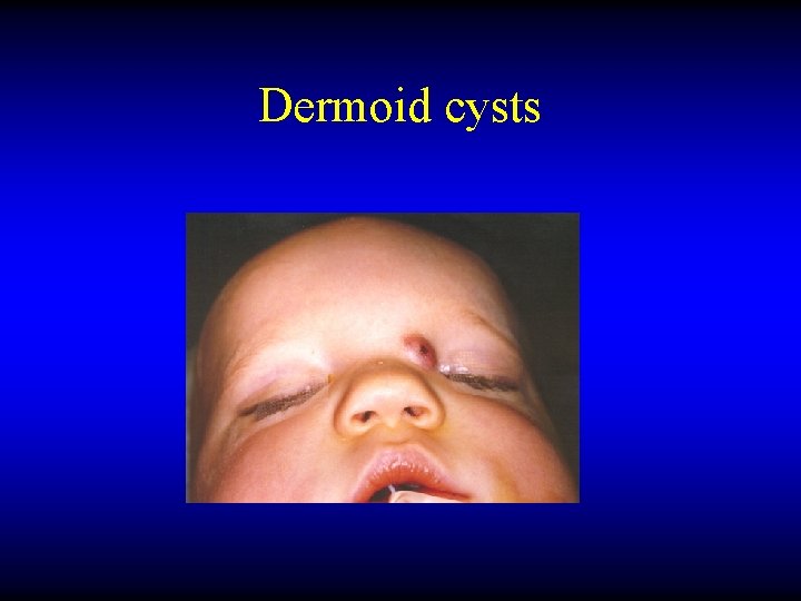 Dermoid cysts 