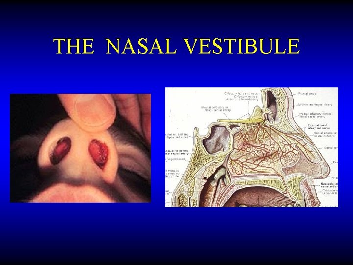 THE NASAL VESTIBULE 