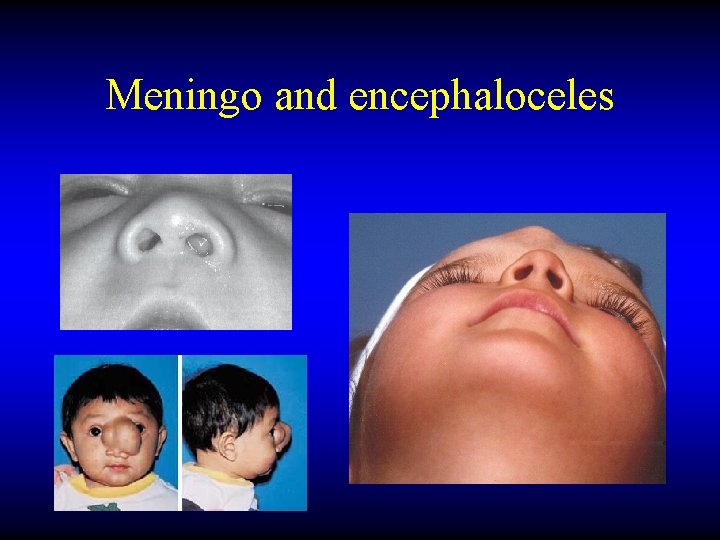 Meningo and encephaloceles 