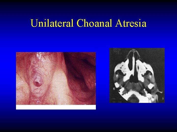 Unilateral Choanal Atresia 