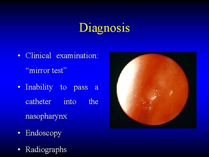 Diagnosis • Clinical examination: “mirror test” • Inability to pass a catheter into nasopharynx