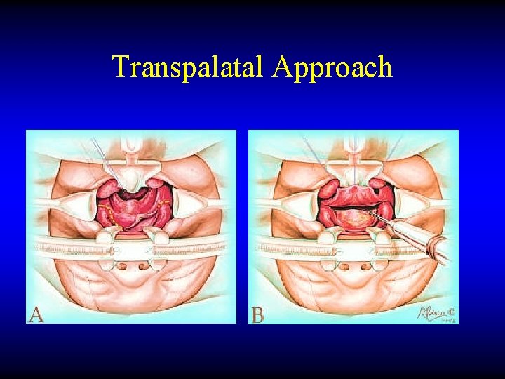 Transpalatal Approach 