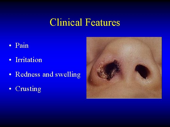 Clinical Features • Pain • Irritation • Redness and swelling • Crusting 