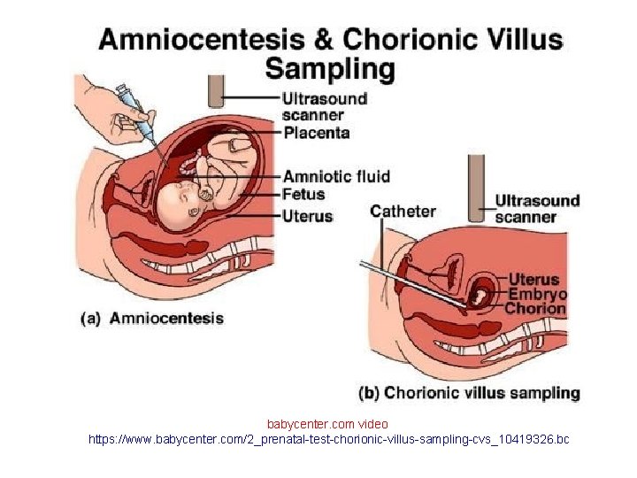 babycenter. com video https: //www. babycenter. com/2_prenatal-test-chorionic-villus-sampling-cvs_10419326. bc 