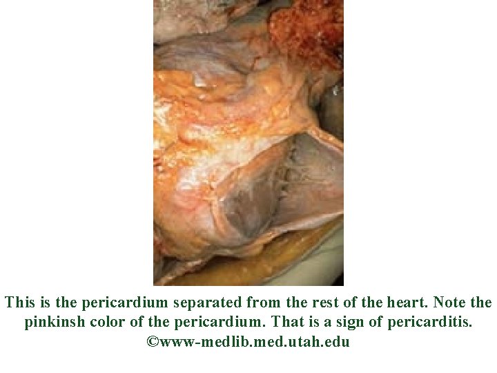 This is the pericardium separated from the rest of the heart. Note the pinkinsh