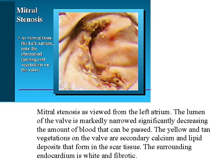 Mitral stenosis as viewed from the left atrium. The lumen of the valve is