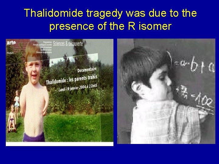 Thalidomide tragedy was due to the presence of the R isomer 